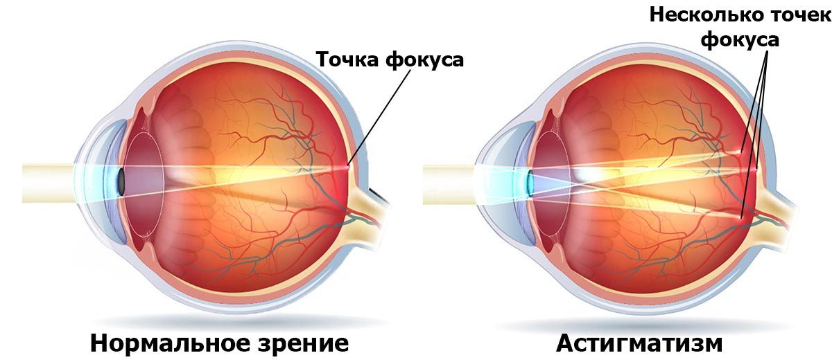 Как видит человек с астигматизмом и близорукостью картинки