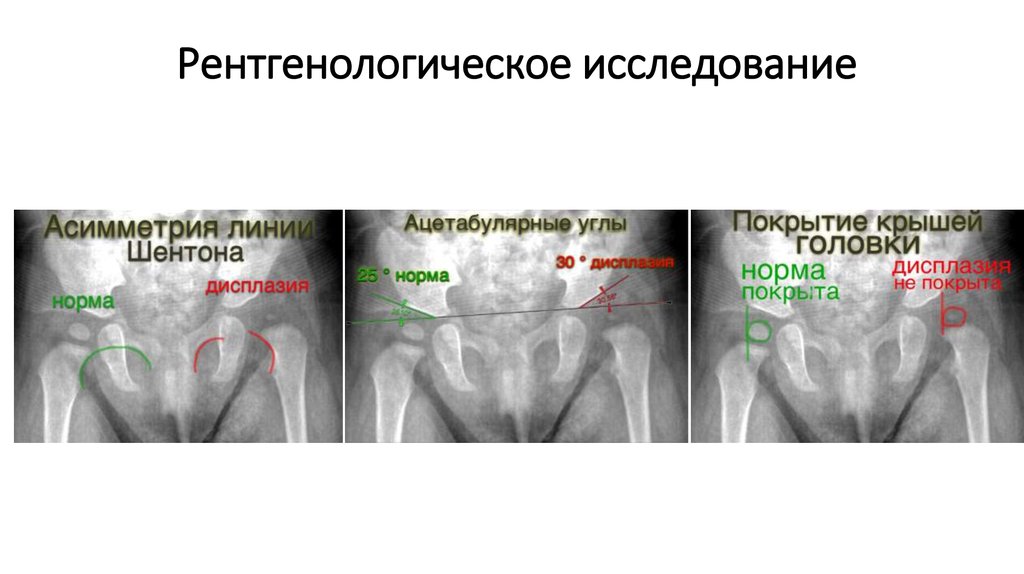 Схема хильгенрейнера тазобедренных суставов у детей