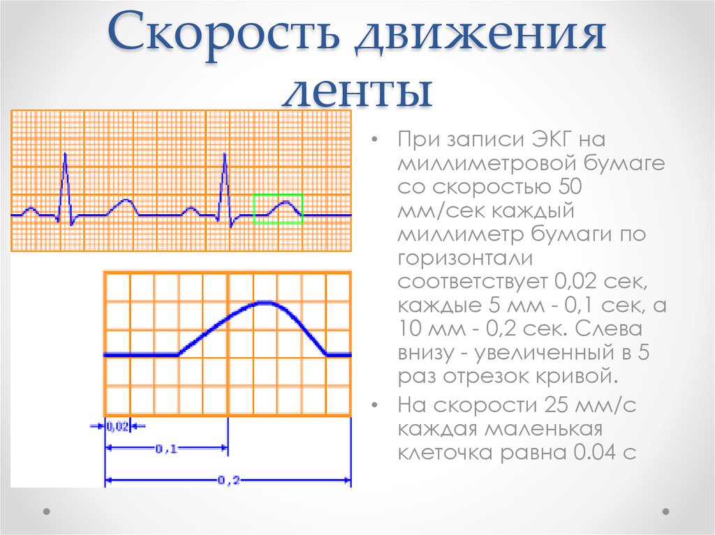 25 скорость. Скорость записи ЭКГ 50 мм с. При записи ЭКГ на миллиметровой бумаге со скоростью 50 мм/сек. Скорость записи 50 мм в сек ЭКГ. Скорость движения ленты при записи ЭКГ.