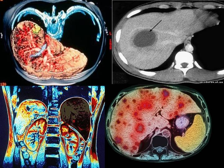 Как выглядят метастазы в печени на кт с контрастом фото