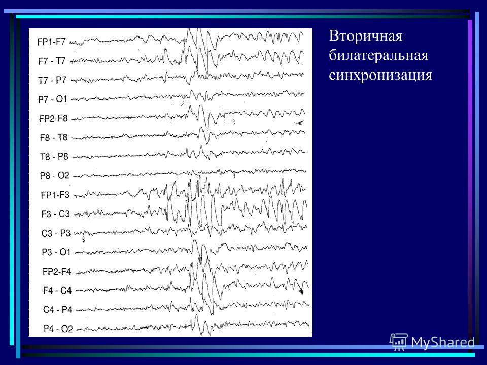 Билатерально синхронная вспышка