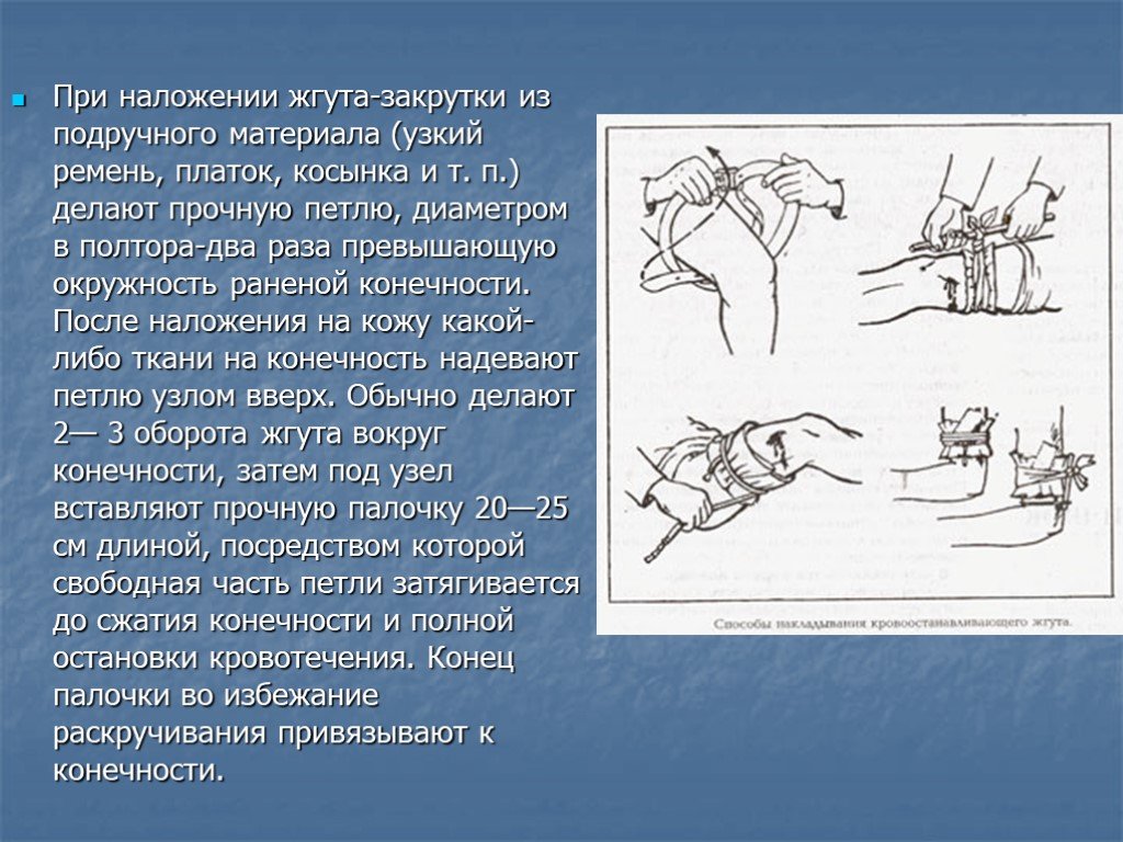 Способ наложения. Наложение жгута закрутки. Методика наложения жгута закрутки. Наложение кровоостанавливающего жгута закрутки. Наолжение эгута закрутка.