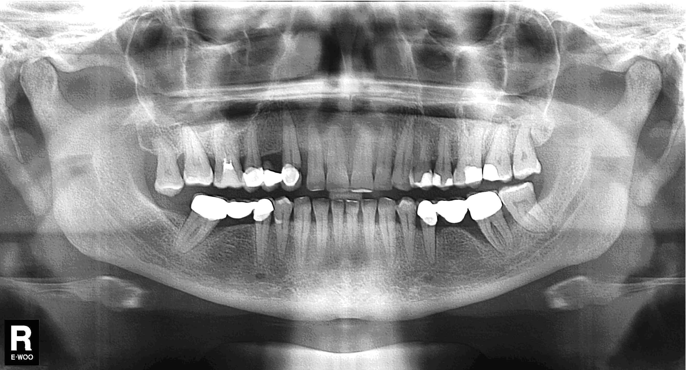 Рентген зубов Томск Ладный Лечение кариеса Томск Новосибирская