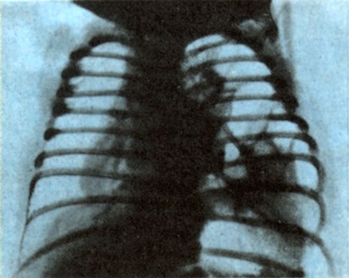 Рис. 2. Рентгенограмма грудной клетки ребенка с врожденной левосторонней диафрагмальной грыжей (прямая проекция): субтотальное затемнение левого легочного поля, обусловленное диафрагмальной грыжей