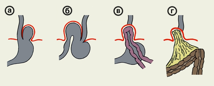 Рис. 5. Схематическое изображение различных видов параэзофагеальных хиатальных грыж: а — фундаментальная; б — антральная; в — кишечная; г — сальниковая